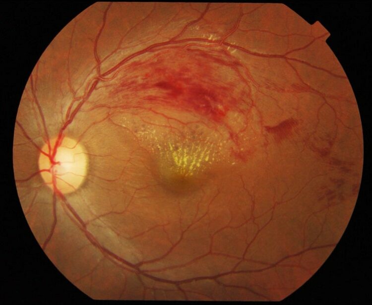 Retinal Vein Occlusion