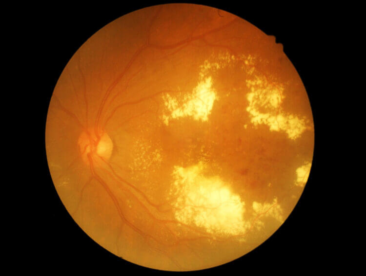 Diabetic Retinopathy