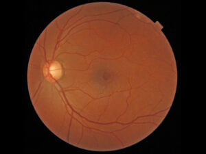 Epiretinal Membrane - Retina Consultants Of Michigan