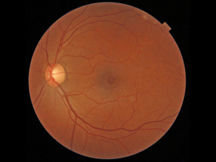 Epiretinal Membranes