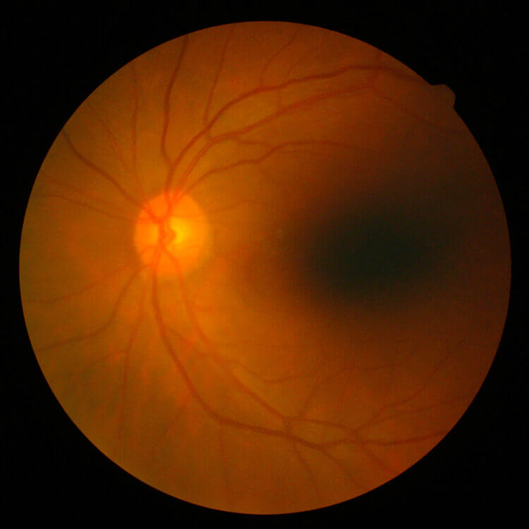 Retinal detachment