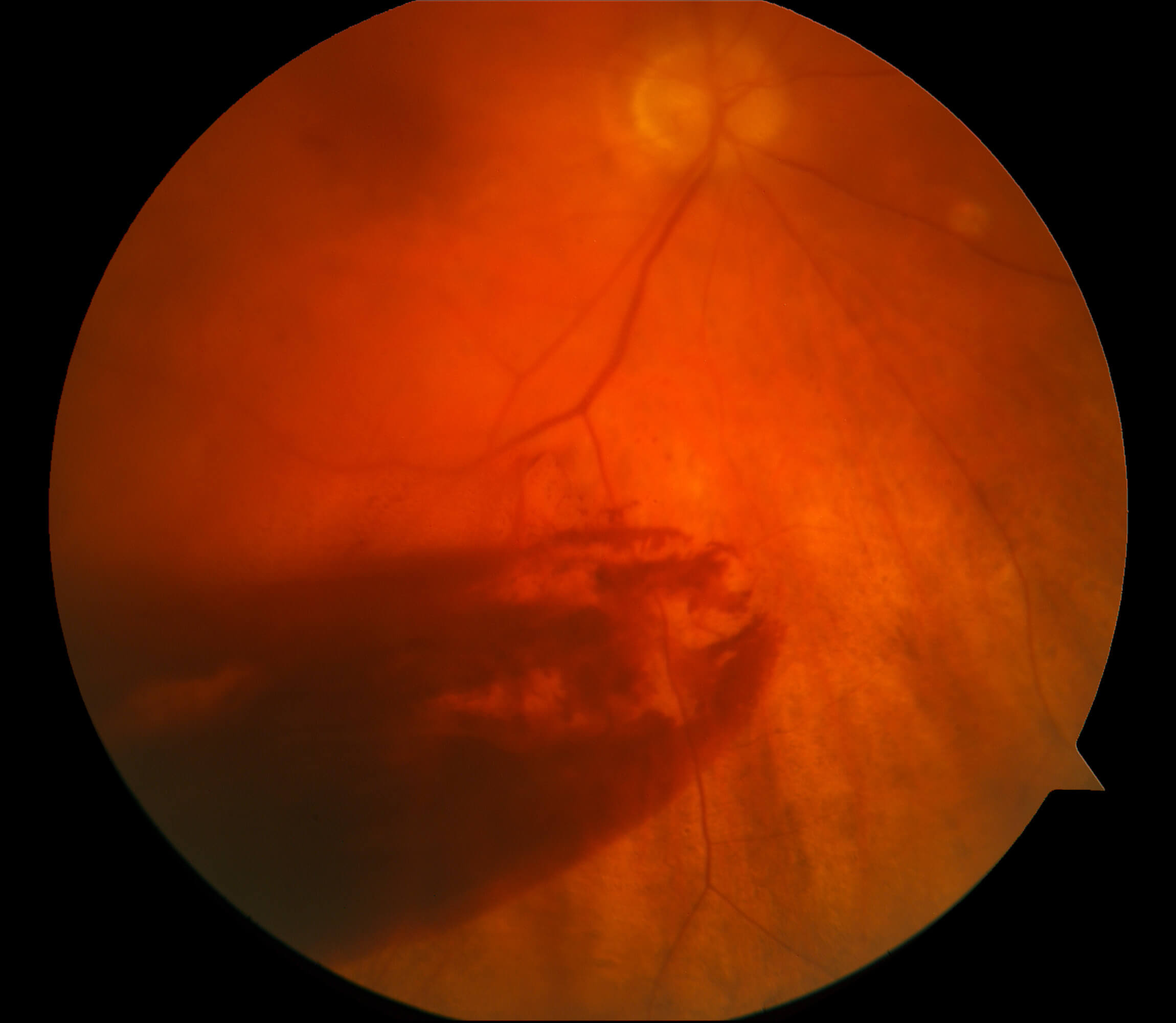 Intraretinal Hemorrhage